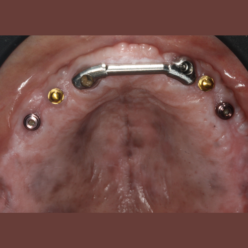 Dental Implants Troy MI