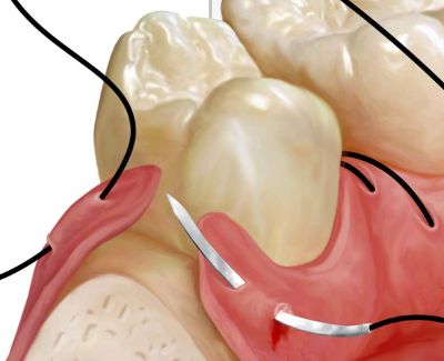 Dental Implant Training MI